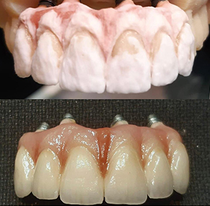 Implantes